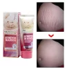 كريم لإزالة علامات التمدد والخطوط البيضاء نهائيًا Stretch Marks