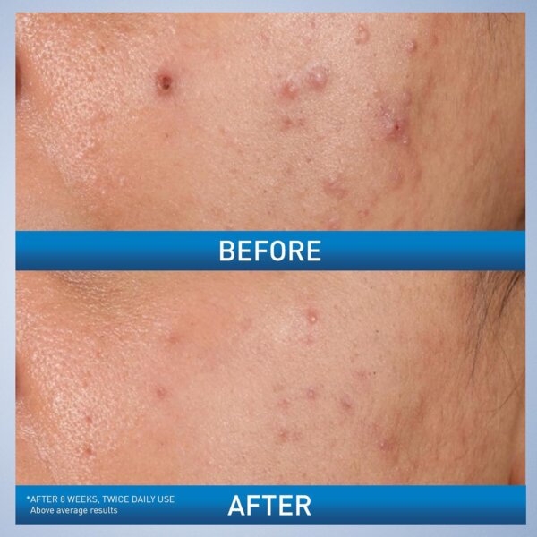 جل CeraVe علاجي حمض الساليسيليك Salicylic Acid Acne لحب الشباب وتنظيف المسام والرؤوس السوداء