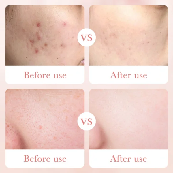 تونر الورد وحمض الهيالورونيك - ترطيب، تهدئة، وتنقية المسام Rose Hyaluronic Acid Toner (11) بكج 5 قطع الورد وحمض الهيالورونيك (تونر + لوشن + كريم العين + سيروم + غسول) Rose Hyaluronic