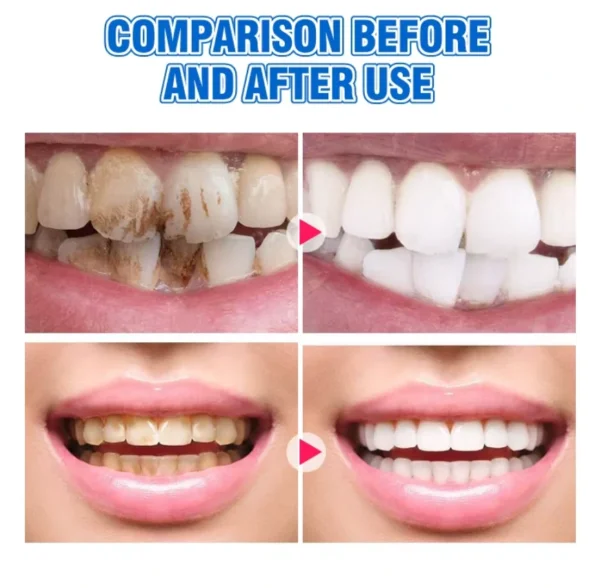 مسحوق بودرة تبييض الاسنان بحمض الهيالورونيك لإزالة التصبغات والجير والبلاك