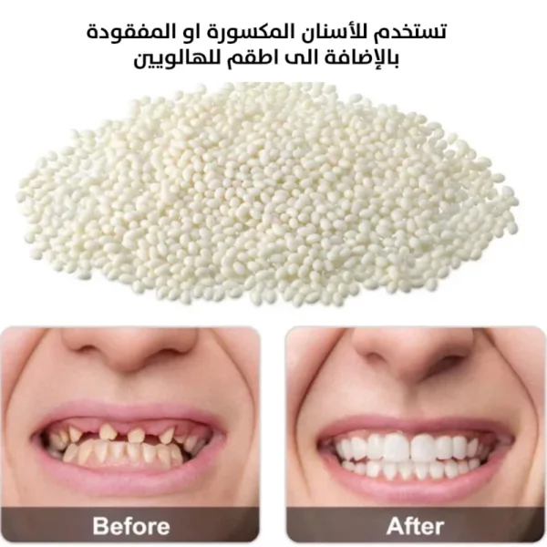 معجون راتنج لتشكيل سن مؤقت (Moldable False Teeth) حبيبات ريزن قابلة للتشكيل