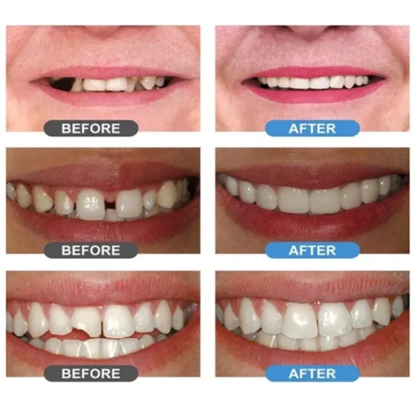 معجون راتنج لتشكيل سن مؤقت (Moldable False Teeth) حبيبات ريزن قابلة للتشكيل