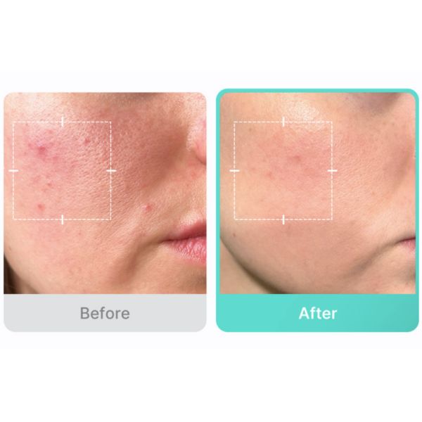 بكج البشرة الصافية (بدون حبوب ومسامات) Medicube Clear Skin - منتجات كورية